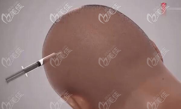 術(shù)前在取發(fā)區(qū)注射麻藥