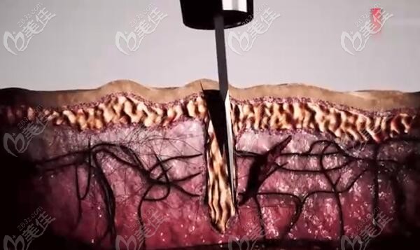 種植頭發(fā)前要寶石刀打孔
