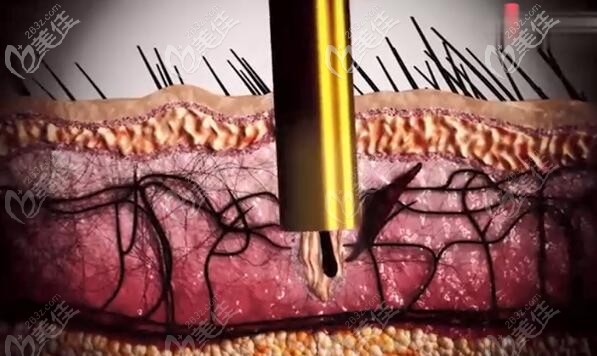 電動毛囊提取儀提取健康毛囊