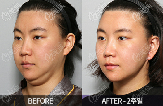 韓國Liting整形外科面部提升去雙下巴<span style= 韓國Liting整形外科面部提升去雙下巴<span style=