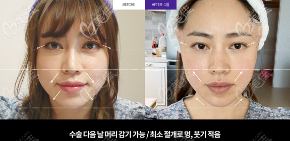 韓國Liting整形外科面部小拉皮手術(shù)<span style= 韓國Liting整形外科面部小拉皮手術(shù)<span style=