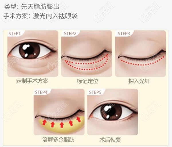 劉強(qiáng)醫(yī)生做激光祛眼袋手術(shù)過程圖 劉強(qiáng)醫(yī)生做激光祛眼袋手術(shù)過程圖