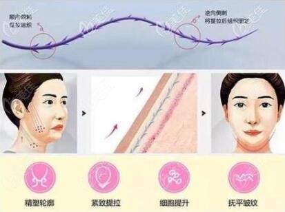 沈陽騰采醫(yī)療美容做面部埋線提升效果怎么樣