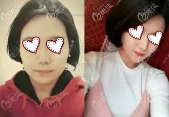 沈陽騰采醫(yī)療美容做面部埋線提升真人對比案例照