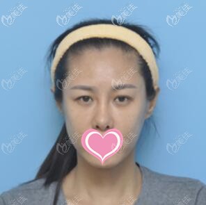 找楊慶峰割雙眼皮術(shù)前照 找楊慶峰割雙眼皮術(shù)前照