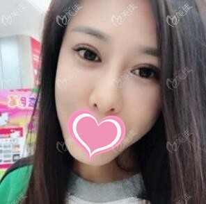 全切雙眼皮術(shù)后18天恢復(fù)照 全切雙眼皮術(shù)后18天恢復(fù)照