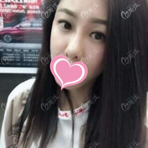 沈陽楊慶峰做雙眼皮到底怎么樣？我找他做的全切雙眼皮1個(gè)月后眼睛恢復(fù)得很自然了