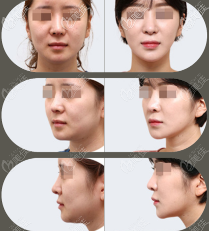 韓國原辰康文碩院長全面部提升效果圖 韓國原辰康文碩院長全面部提升效果圖