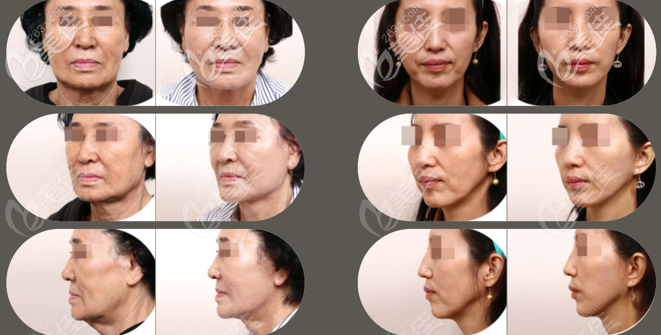 韓國原辰全臉部大拉皮手術(shù)效果圖 韓國原辰全臉部大拉皮手術(shù)效果圖