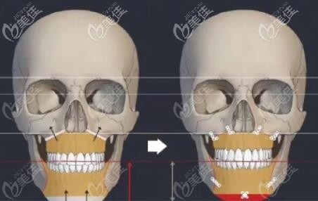 雙鄂手術(shù)過程圖解