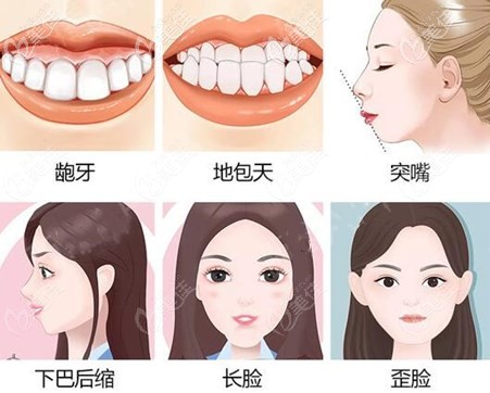 做雙鄂手術(shù)的適應(yīng)癥