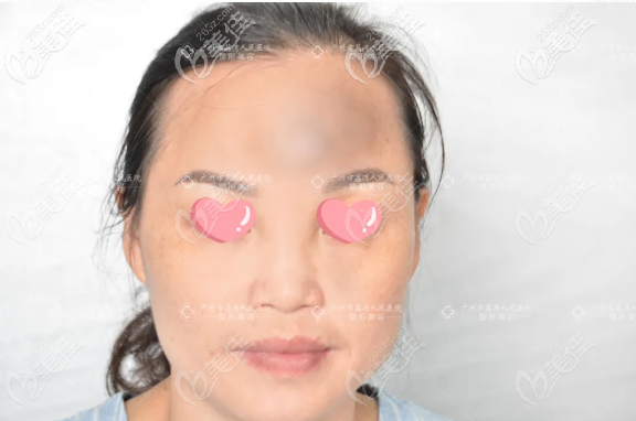 廣州荔灣區(qū)人民醫(yī)院整形美容中心齊云香術(shù)前照片1