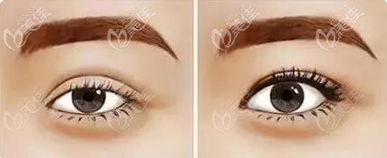 提肌與不提肌的區(qū)別到底在哪