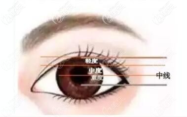 做雙眼皮的時(shí)候到底該不該提??？