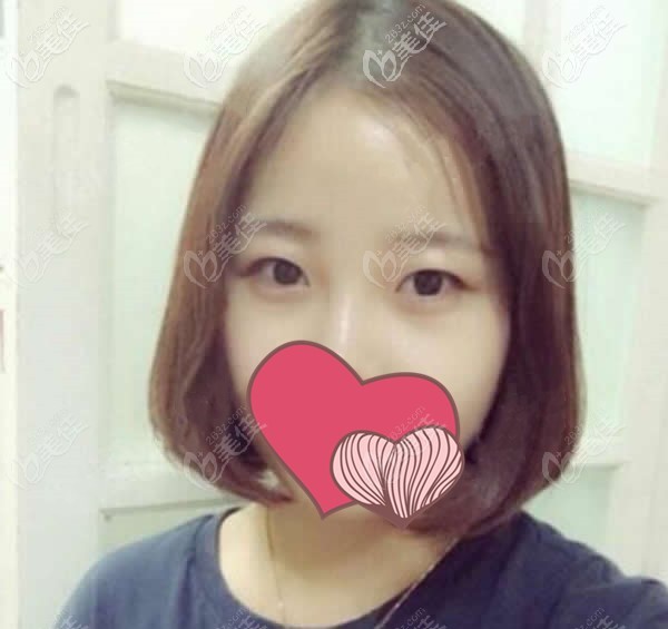 去蘭州五星嘉琳整形做雙眼皮術(shù)前照 去蘭州五星嘉琳整形做雙眼皮術(shù)前照