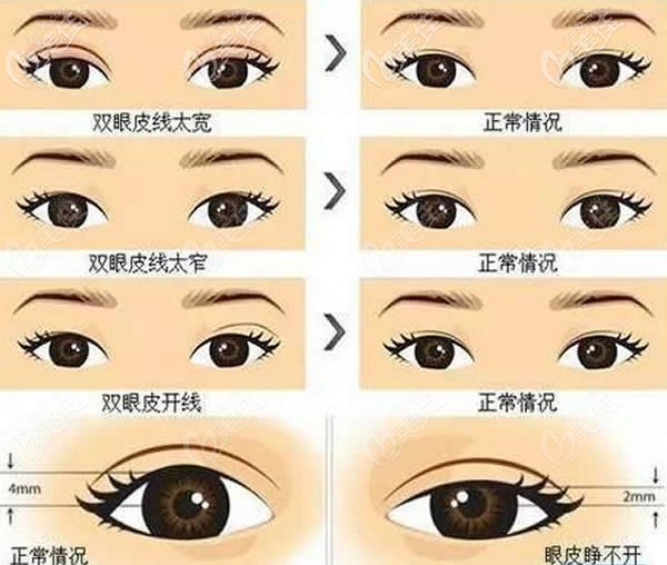 雙眼皮失敗表現(xiàn)癥狀 雙眼皮失敗表現(xiàn)癥狀