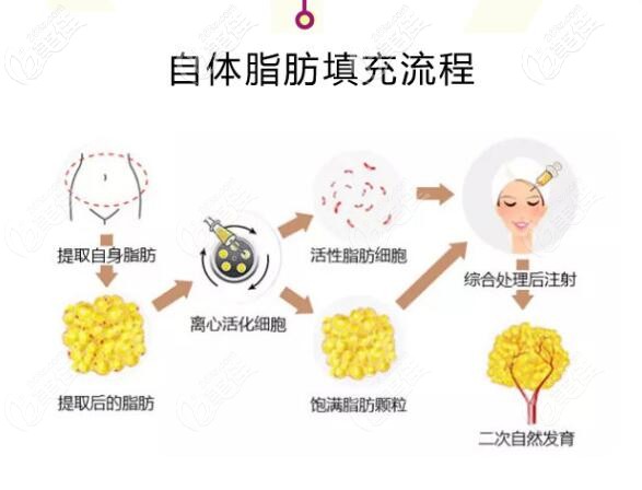 大同清木<!--<i data=20240703-sp></i>-->自體脂肪填充流程