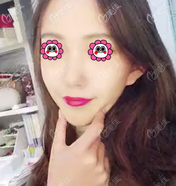 做蛋白線面部提升沒有副作用好開心