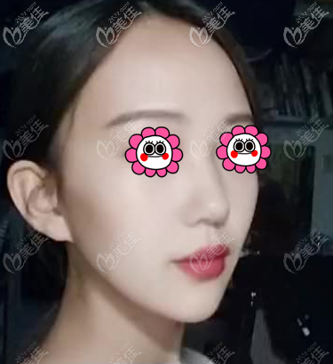 做蛋白線面部提升到現(xiàn)在沒有發(fā)現(xiàn)副作用,不信這有我的恢復圖參考