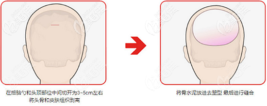 韓國愛婷骨水泥填充后腦勺切口 韓國愛婷骨水泥填充后腦勺切口