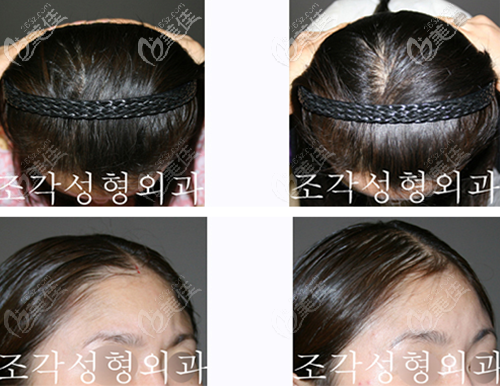 韓國愛婷骨水泥填充后腦勺案例 韓國愛婷骨水泥填充后腦勺案例