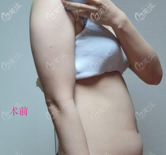 手臂術(shù)前的照片 手臂術(shù)前的照片