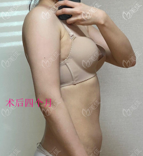 我兩側(cè)手臂吸脂600CC能瘦2厘米變細(xì)一圈，并且一直沒(méi)有反彈