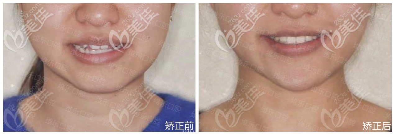 福州維樂家的正畸案例