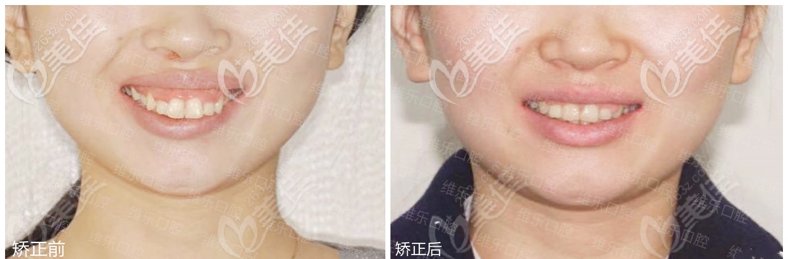正畸前后對比圖