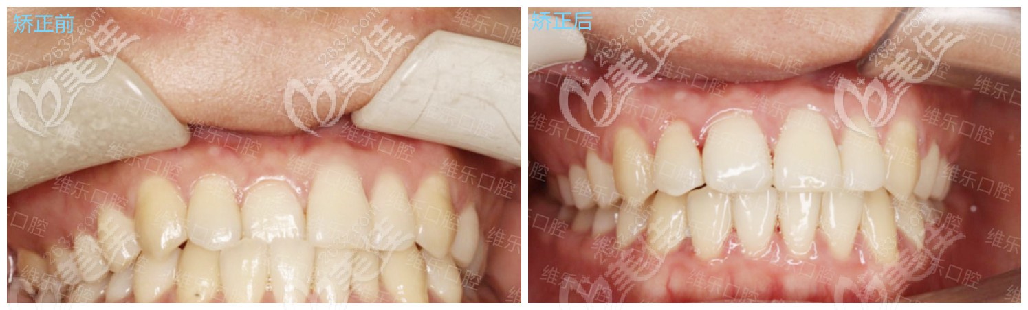 陳先生在福州維樂矯正后的效果