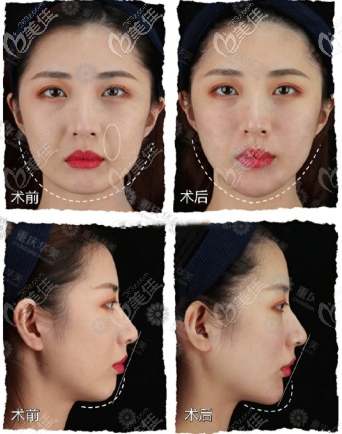重慶華美面部下頜緣提升效果圖