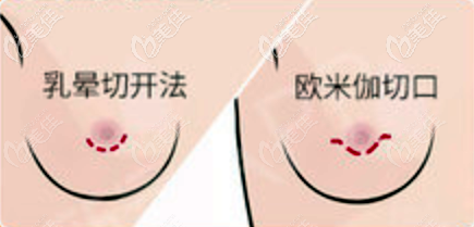 歐米伽隱形微創(chuàng)切口