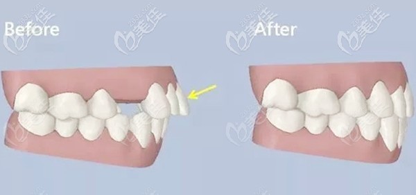拔牙正畸收縫前后效果圖