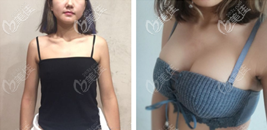 深圳軍科劉月更醫(yī)生300cc傲諾拉璀璨隆胸圖