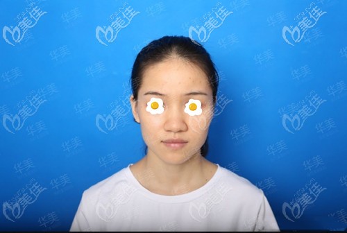 軟糖鼻綜合術(shù)前照片 軟糖鼻綜合術(shù)前照片