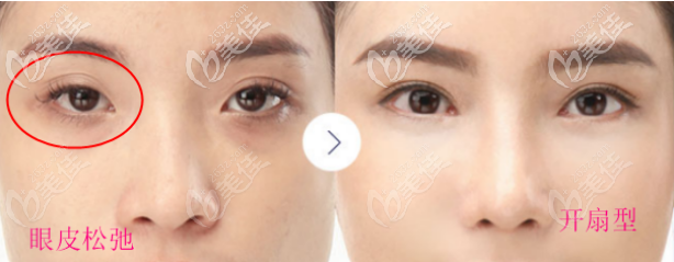 上眼皮松弛凹陷適合做窄的開扇型雙眼皮哦，這比做提眉適合多了  