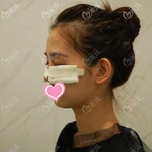 做祛眼袋手術(shù)術(shù)后效果 做祛眼袋手術(shù)術(shù)后效果