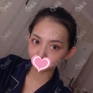 內(nèi)切去眼袋術(shù)后7天照 內(nèi)切去眼袋術(shù)后7天照