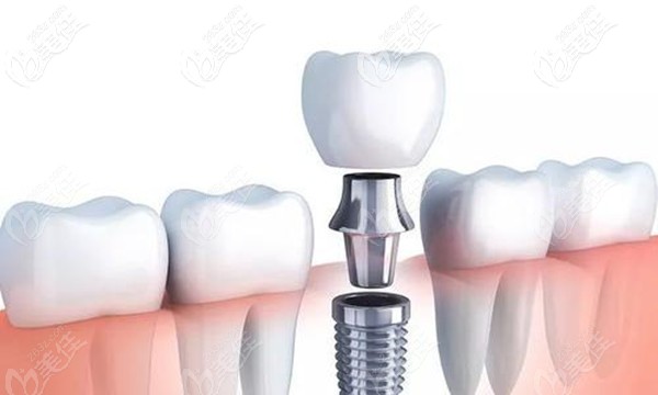 瑞士ITI種植系統(tǒng)