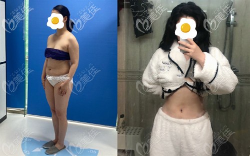 深圳藝星腰腹吸脂案例 深圳藝星腰腹吸脂案例