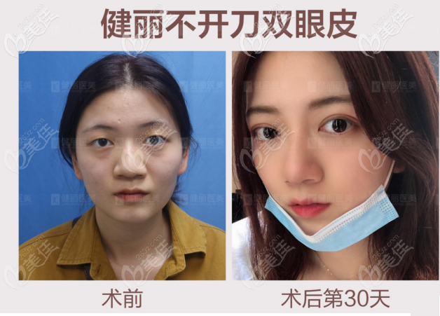 廣州健麗醫(yī)美雙眼皮案例分享,健麗不開刀雙眼皮效果確實(shí)不錯