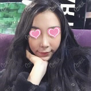 玻尿酸填充面部術(shù)后8天照 玻尿酸填充面部術(shù)后8天照