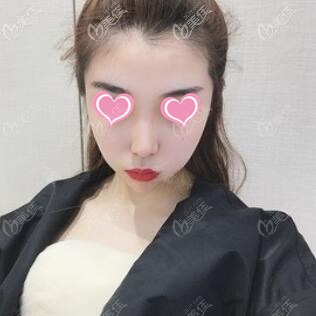 玻尿酸填充面部術(shù)后16天照 玻尿酸填充面部術(shù)后16天照