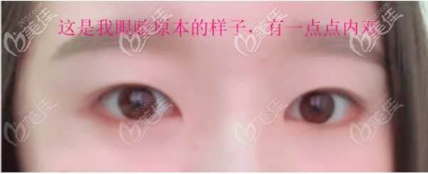 這是我做全切雙眼皮術前的樣子 這是我做全切雙眼皮術前的樣子