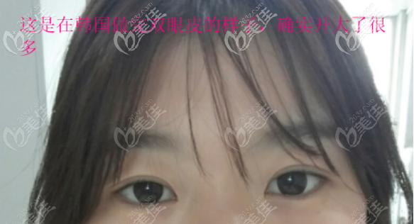 這是我在韓國做全切雙眼皮的樣子 這是我在韓國做全切雙眼皮的樣子