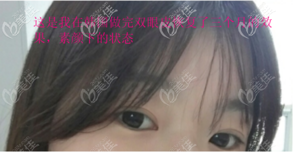 關(guān)于韓國做全切雙眼皮好還是國內(nèi)好，讓做過兩次雙眼皮的我來說說吧