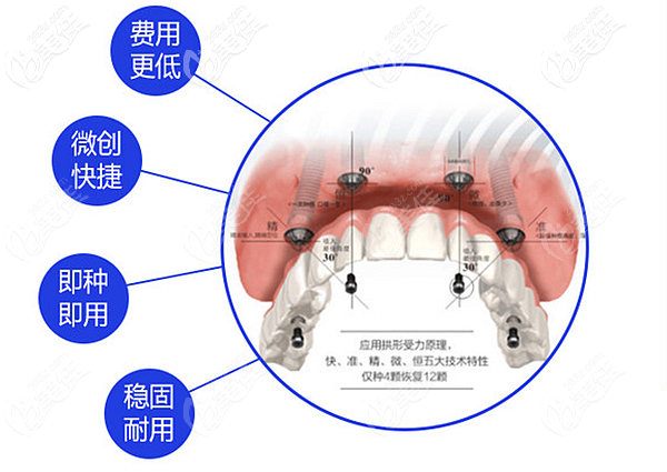 立得用all-on-4半口種植牙