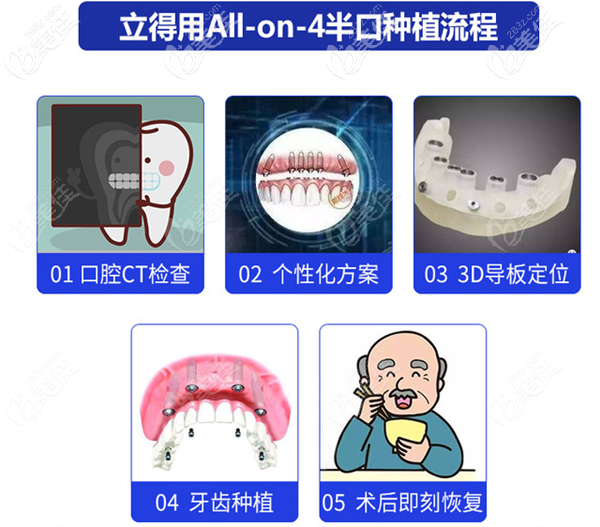 西安中諾立得用all-on-4半口種植牙