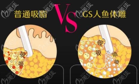 大連達(dá)美元辰GS人魚體雕術(shù)吸脂