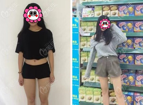 武漢仁愛時光5g天使光雕大腿吸脂